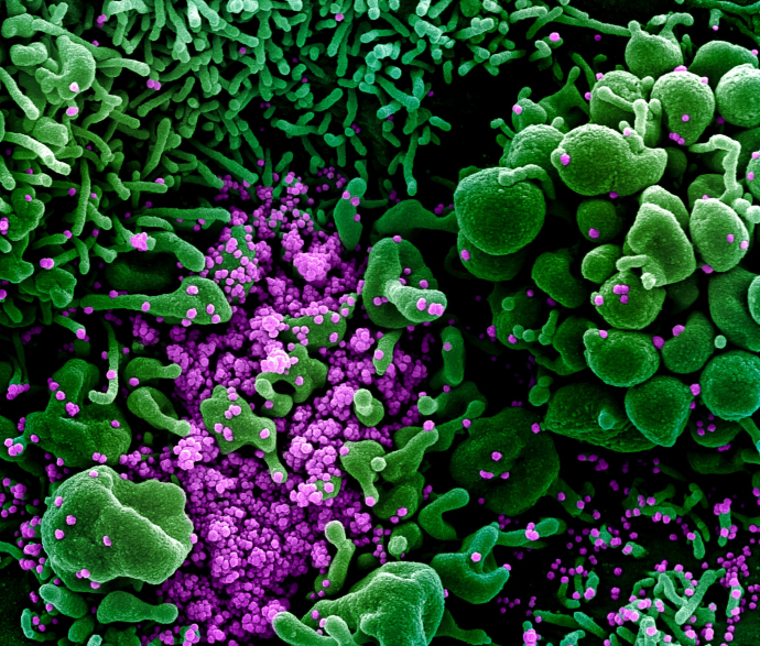 Colourised scanning electron micrograph of a cell (green) heavily infected with SARS-CoV-2 (purple); image credit: NIAID