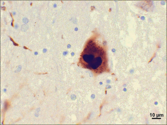 Micrograph of clumps of alpha-synuclein protien in the brain of a patient with Parkinson's disease